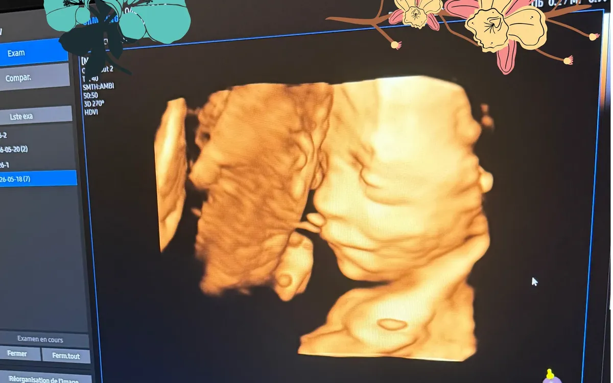 À partir de quand peut-on connaître le sexe du bébé à l’échographie ?